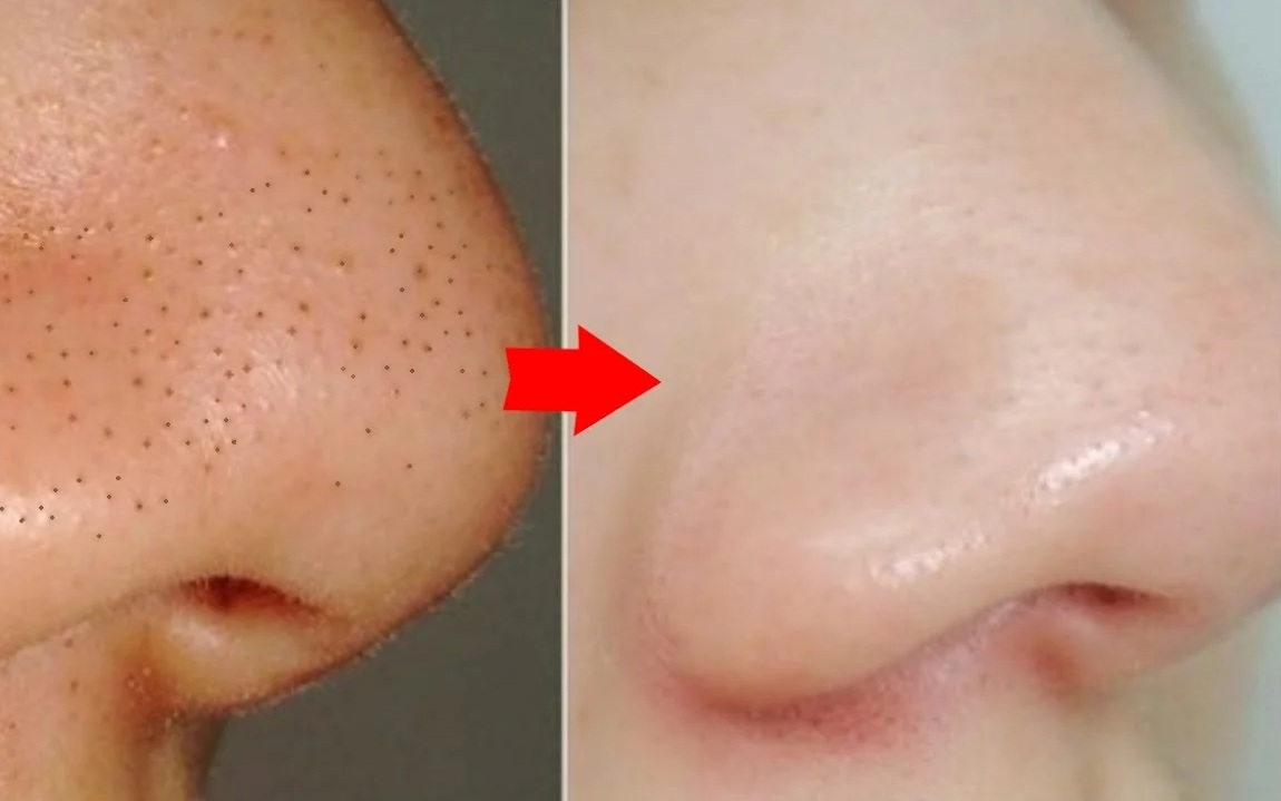 ازالة الرؤوس السوداء بأفضل طريقة مع جهاز Youpin Clean skin blackhead